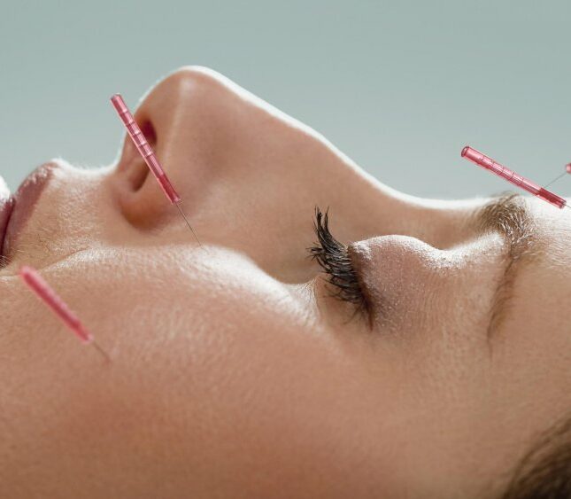 acupuncture-visage acupuncture-visage