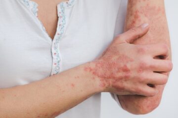 traitement efficace contre le psoriasis